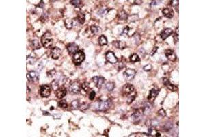 IHC analysis of FFPE human hepatocarcinoma tissue stained with the SIRT7 antibody (SIRT7 抗体  (AA 331-360))
