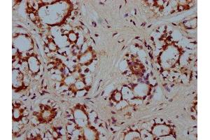 IHC image of ABIN7155703 diluted at 1:300 and staining in paraffin-embedded human breast cancer performed on a Leica BondTM system. (HMX2 抗体  (AA 1-150))