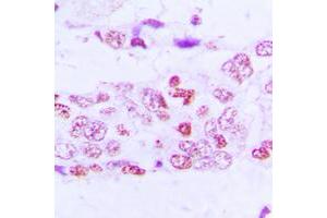 Immunohistochemical analysis of GSK3 alpha/beta (pY279/216) staining in human lung cancer formalin fixed paraffin embedded tissue section. (GSK3 alpha/beta 抗体  (pTyr216, pTyr279))