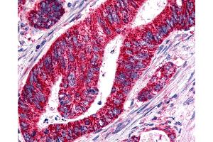 Anti-BOB / GPR15 antibody IHC of human Colon, Carcinoma. (GPR15 抗体  (Cytoplasmic Domain))