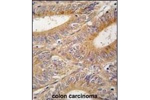 Formalin-fixed and paraffin-embedded human colon carcinoma tissue reacted with AIK antibody (N-term) (ABIN392389 and ABIN2842017) , which was peroxidase-conjugated to the secondary antibody, followed by DAB staining. (Aurora A 抗体  (N-Term))