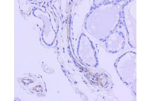 Immunohistochemistry of paraffin-embedded human thyroid using ROCK1 antibody (ABIN5997107) at dilution of 1/100 (40x lens). (ROCK1 抗体)