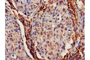 IHC image of ABIN7156683 diluted at 1:700 and staining in paraffin-embedded human lung cancer performed on a Leica BondTM system. (IFITM2 抗体  (AA 1-56))