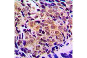 Immunohistochemical analysis of Histone Deacetylase 5/9 staining in human prostate cancer formalin fixed paraffin embedded tissue section. (HDAC5/9 抗体  (Center))