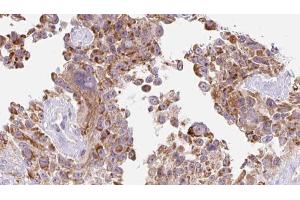 ABIN6273218 at 1/100 staining Human Melanoma tissue by IHC-P. (CTHRC1 抗体  (Internal Region))