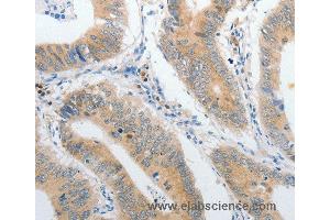 Immunohistochemistry of Human lung cancer using PIBF1 Polyclonal Antibody at dilution of 1:60 (PIBF1 抗体)