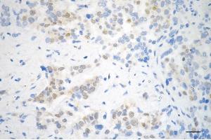 Immunohistochemistry was performed on paraffin-embedded human breast carcinoma using STAT5B antibody (ABIN7800348), 1:200). (Recombinant STAT5B 抗体)