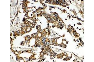 IHC-P: HNF6 antibody testing of human liver cancer tissue (ONECUT1 抗体  (N-Term))