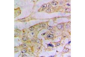 Immunohistochemical analysis of Ferritin L staining in human lung cancer formalin fixed paraffin embedded tissue section. (Ferritin L 抗体)