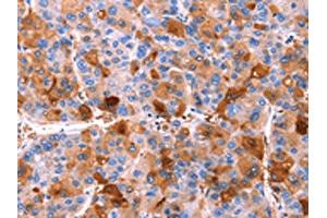 The image on the left is immunohistochemistry of paraffin-embedded Human liver cancer tissue using ABIN7190588(ERN2 Antibody) at dilution 1/40, on the right is treated with synthetic peptide. (ERN2 抗体)