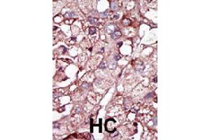 Formalin-fixed and paraffin-embedded human hepatocellular carcinoma tissue reacted with ACVRL1 polyclonal antibody  , which was peroxidase-conjugated to the secondary antibody, followed by DAB staining. (ACVRL1 抗体  (N-Term))