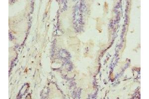 Immunohistochemistry of paraffin-embedded human prostate cancer using ABIN7168074 at dilution of 1:100 (Rhotekin 抗体  (AA 304-563))