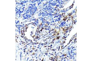 Immunohistochemistry of paraffin-embedded human lung cancer using CD9 Rabbit mAb (ABIN7266227) at dilution of 1:100 (40x lens). (CD9 抗体)