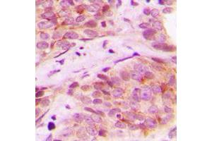 Immunohistochemical analysis of Mammaglobin B staining in human breast cancer formalin fixed paraffin embedded tissue section. (SCGB2A1 抗体  (N-Term))