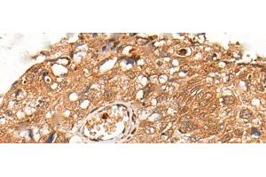 Immunohistochemistry of paraffin-embedded Human lung cancer tissue using KLHL36 Polyclonal Antibody at dilution of 1:55(x200) (KLHL36 抗体)