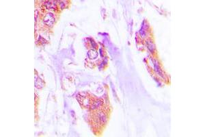 Immunohistochemical analysis of Cardiotrophin-1 staining in human lung cancer formalin fixed paraffin embedded tissue section. (Cardiotrophin 1 抗体  (N-Term))