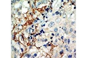 IHC analysis of FFPE human breast carcinoma tissue stained with the EphA3 antibody (EPH Receptor A3 抗体  (AA 115-144))