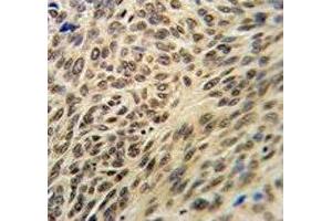 XRCC6 antibody IHC analysis in formalin fixed and paraffin embedded human lung carcinoma. (XRCC6 抗体  (AA 521-548))