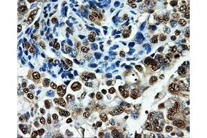 Immunohistochemical staining of paraffin-embedded Adenocarcinoma of breast tissue using anti-PKMYT1 mouse monoclonal antibody. (PKMYT1 抗体)