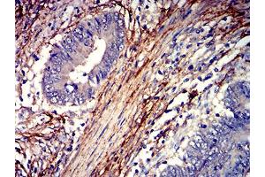 Immunohistochemical analysis of paraffin-embedded rectum cancer tissues using F2R mouse mAb with DAB staining. (PAR1 抗体  (AA 42-176))