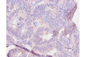 Immunohistochemistry of paraffin-embedded human colon cancer using ABIN7179323 at dilution of 1:10 (IL12B 抗体  (AA 23-327))