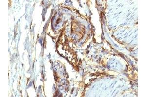 Formalin-fixed, paraffin-embedded human colon carcinoma stained with CD34 antibody (QBEnd/10 + HPCA1/763)