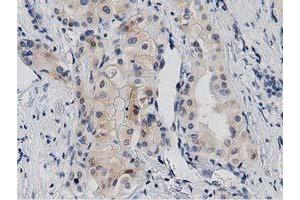 Immunohistochemical staining of paraffin-embedded Carcinoma of Human thyroid tissue using anti-PRKD2 mouse monoclonal antibody. (PKD2 抗体)