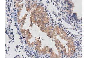Immunohistochemical staining of paraffin-embedded Carcinoma of Human prostate tissue using anti-PTPRE mouse monoclonal antibody. (PTPRE 抗体)
