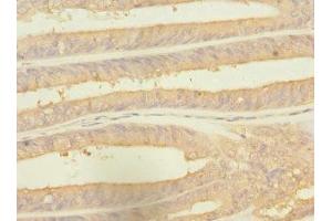 Immunohistochemistry of paraffin-embedded human endometrial cancer using ABIN7142540 at dilution of 1:100 (RPS27 抗体  (AA 1-84))