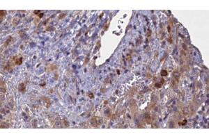 ABIN6276889 at 1/100 staining Human liver cancer tissue by IHC-P. (GABRA2 抗体  (N-Term))