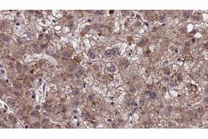 ABIN6273971 at 1/100 staining Human liver cancer tissue by IHC-P. (OR1J2/1N2 抗体)