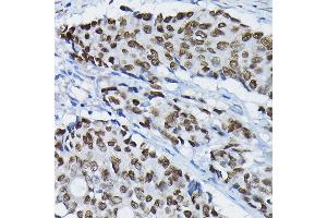 Immunohistochemistry of paraffin-embedded human colon carcinoma using S Rabbit pAb (ABIN7270154) at dilution of 1:100 (40x lens). (SATB2 抗体  (AA 540-620))