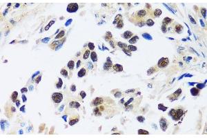 Immunohistochemistry of paraffin-embedded Human lung cancer using ASCL4 Polyclonal Antibody at dilution of 1:100 (40x lens). (ASCL4 抗体)