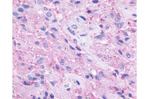 Anti-GPR148 antibody IHC of human Brain, Glioblastoma. (GPR148 抗体  (Cytoplasmic Domain))