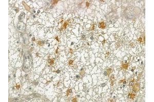 ABIN6257055 and ABIN6274988 at 1/100 staining human thyroid carcinoma by IHC-P. (CEP170 抗体  (Internal Region))