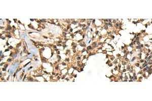 Immunohistochemistry of paraffin-embedded Human ovarian cancer tissue using CASK Polyclonal Antibody at dilution of 1:65(x200) (CASK 抗体)