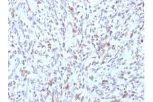 Formalin-fixed, paraffin-embedded human Rhabdomyosarcoma stained with MyoD1 Mouse Recombinant Monoclonal Antibody (rMYD712). (Recombinant MYOD1 抗体)