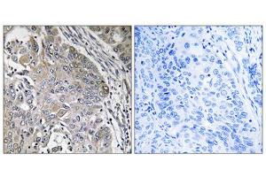 Immunohistochemistry analysis of paraffin-embedded human lung carcinoma tissue using SPINK6 antibody. (SPINK6 抗体  (Internal Region))