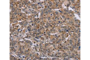 Immunohistochemistry of Human liver cancer using ETV7 Polyclonal Antibody at dilution of 1:30 (ETV7 抗体)