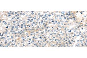 Immunohistochemistry of paraffin-embedded Human breast cancer tissue using TNFAIP8 Polyclonal Antibody at dilution 1:35 (TNFAIP8 抗体)