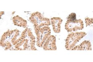Immunohistochemistry of paraffin-embedded Human thyroid cancer tissue using TDP2 Polyclonal Antibody at dilution of 1:75(x200) (TDP2 抗体)