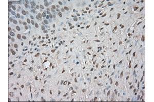 Immunohistochemical staining of paraffin-embedded Adenocarcinoma of colon tissue using anti-BUB1Bmouse monoclonal antibody. (BUB1B 抗体)