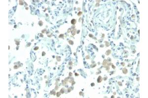 Formalin-fixed, paraffin-embedded human lung stained with Biotin-conjugated Mesothelin Mouse Monoclonal Antibody (MSLN/2131). (Mesothelin 抗体  (AA 273-407) (Biotin))