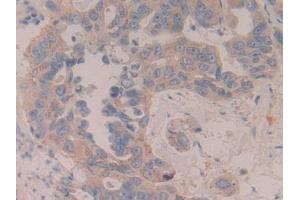Detection of MAP2K6 in Human Breast cancer Tissue using Polyclonal Antibody to Mitogen Activated Protein Kinase Kinase 6 (MAP2K6) (MAP2K6 抗体  (AA 46-306))