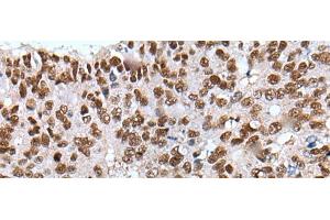 Immunohistochemistry of paraffin-embedded Human colorectal cancer tissue using XAB2 Polyclonal Antibody at dilution of 1:25(x200) (XAB2 抗体)