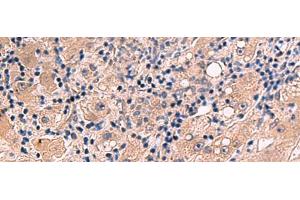 Immunohistochemistry of paraffin-embedded Human liver cancer tissue using INSM2 Polyclonal Antibody at dilution of 1:35(x200) (INSM2 抗体)