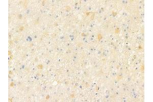 ABIN6258145 and ABIN6273917 at 1/100 staining human astrocytoma by IHC-P.