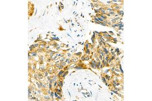 Immunohistochemistry of paraffin embedded human liver cancer using P4H (ABIN7074215) at dilution of 1:700 (400x lens) (HIF Prolyl Hydroxylase 抗体)