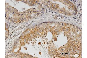 Immunoperoxidase of monoclonal antibody to ERBB2 on formalin-fixed paraffin-embedded human breast cancer. (ErbB2/Her2 抗体  (AA 22-121))