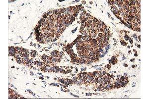 Immunohistochemical staining of paraffin-embedded Adenocarcinoma of Human breast tissue using anti-CLPP mouse monoclonal antibody. (CLPP 抗体)